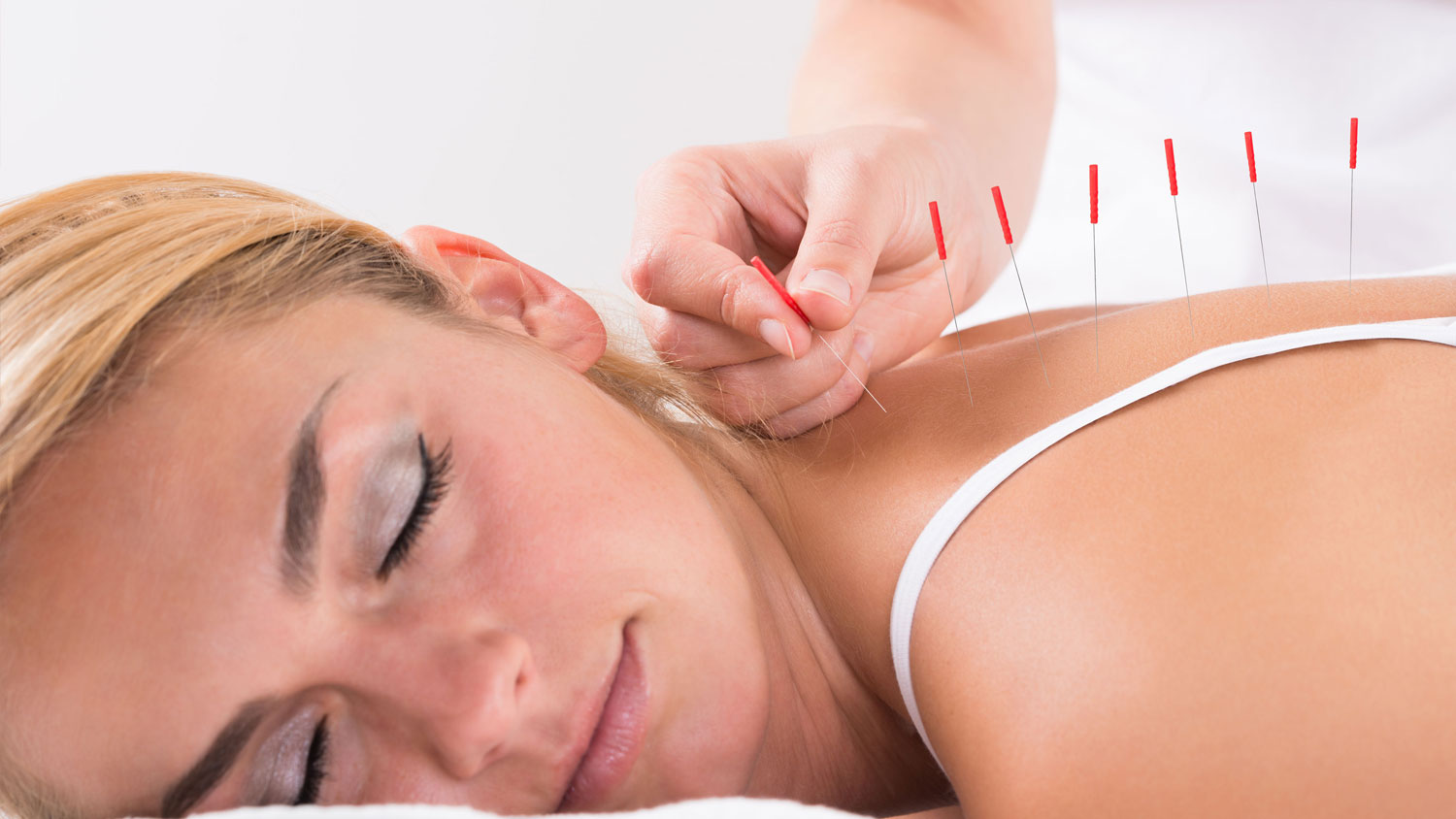 Akupunktur nedir?