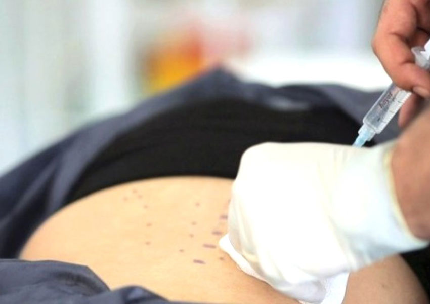 Proloterapi